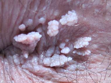 Close up of the anus area, highlighting Anal Warts condition.