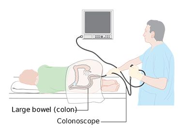 How Big Is The Camera Used For A Colonoscopy How Big Is The Camera Used For A Colonoscopy