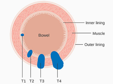 Transversal representation of the bowel, showing the stages of the cancer. Stage one is affecting the inner lining of the bowel wall, stage two is affecting the muscle and the lining, stage three is affecting the inner lining, muscle, outer lining and stage 4 is expanded outside the outer lining.