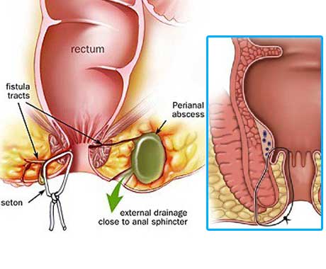 Coloured Representation of a fistulotomy. On the right of the picture is being magnified the fistula area and a seton inserted though the muscle.