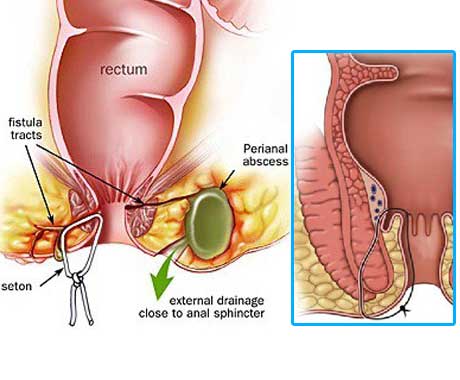 Anal treatment procedure