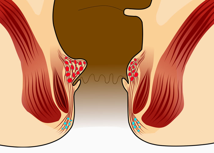 Graphic representation of the anal passage, highlighting two Haemorrhoid