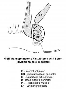 Drawing of high transsphincteric fistulatomy with Seton.