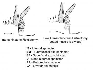 Drawing of interspheric fistulatomy and low transsphincteric.
