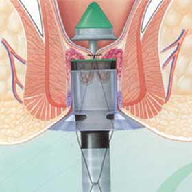 Graphical representation of a procedure for prolapsing hemorrhoids (PPH) procedure. Is being shown a specially designed circular stapler is used to resect the excess tissue and lift the internal hemorrhoidal tissue left behind with interruption of the blood supply from above.