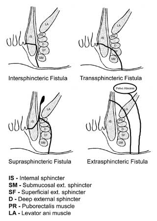 Drawing of Inter-sphincteric, Trans-sphincteric, Supra-sphincteric, Extra-sphincteric fistula, all in the same picture. They represents Parks classification of fistula-in-ano.