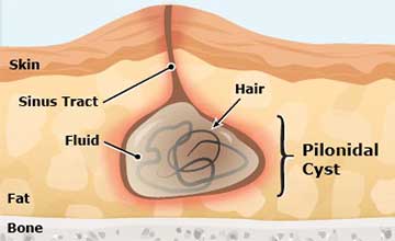 Representation of a human body having a pilonidal sinus condition. On the right of the picture is being magnified the pilonidal cyst area, showing the damaged area of the skin, fat, with the cyst touching the bone.