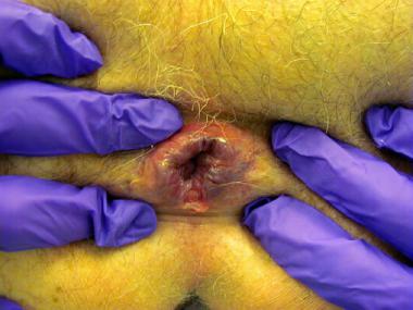 Close up picture of the anus examined by a surgeon wearing purple gloves. It is being highlighted the anal fissure condition where a wall of the anus has splitted.