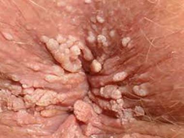 Close up of the anus area, highlighting Anal Warts condition.