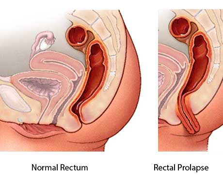 Graphic representation of a normal rectum and rectal prolapse. Full-thickness rectal prolapse is shown as protrusion of the full thickness of the rectal wall through the anus.